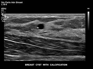 Breast Microcalcifications