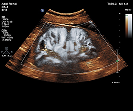 Renal Arteries