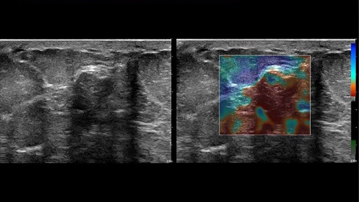 q-app elastography quantification