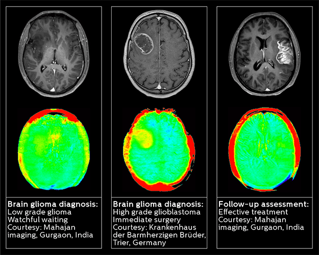 3d apt neuro oncology download image