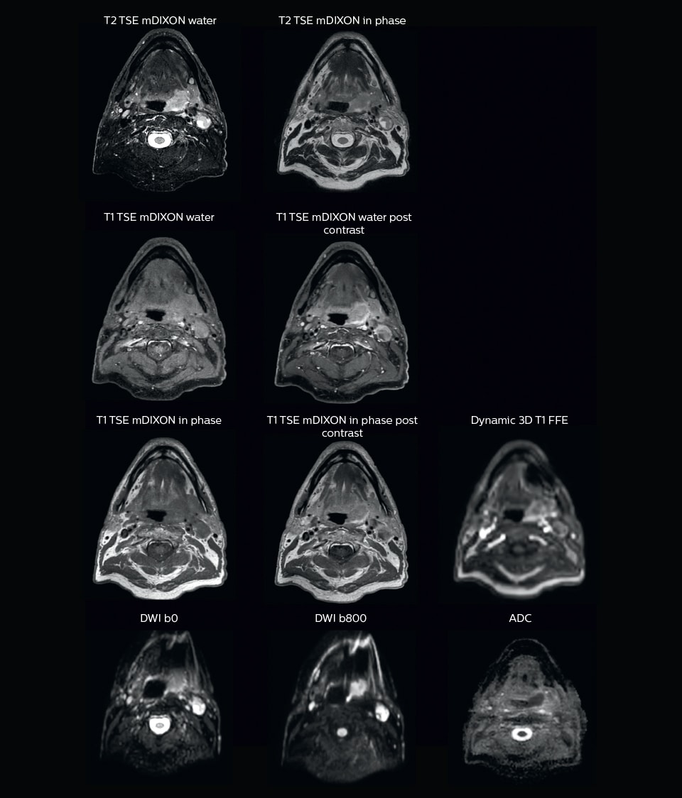 mri of head and neck for radiation therapy planning