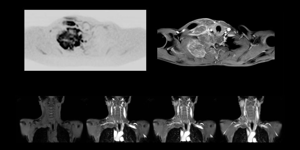 MRI of Pancoast tumor