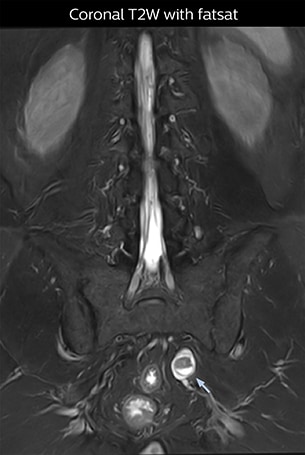 Coronal T2W with fatsat