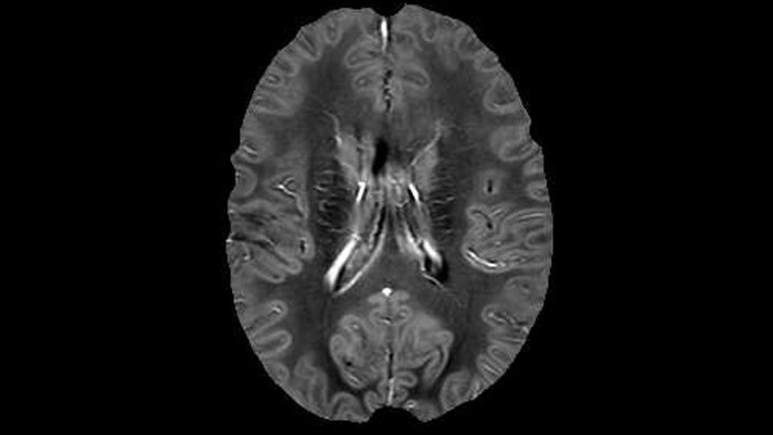 UBC researchers advance their MS imaging | FieldStrength | Philips