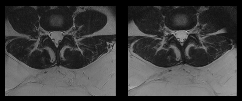 Comparison of two spine sequences with and without Compressed SENSE