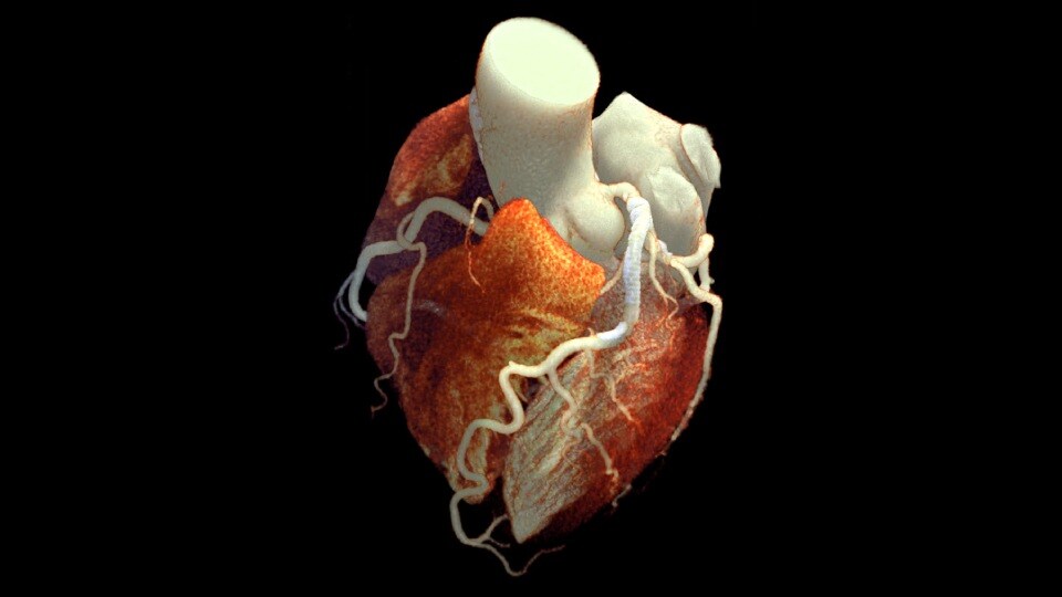 Spectral-detector CT clinical image