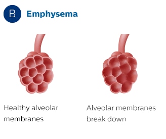 Emphysema