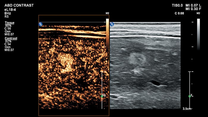 CEUS of liver