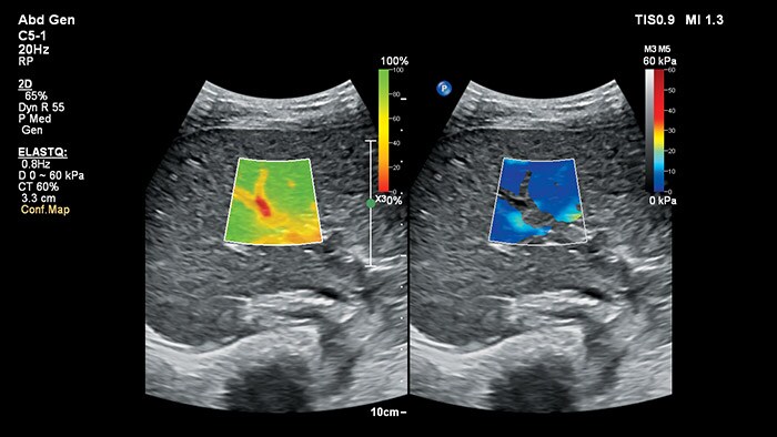 Wave elastography