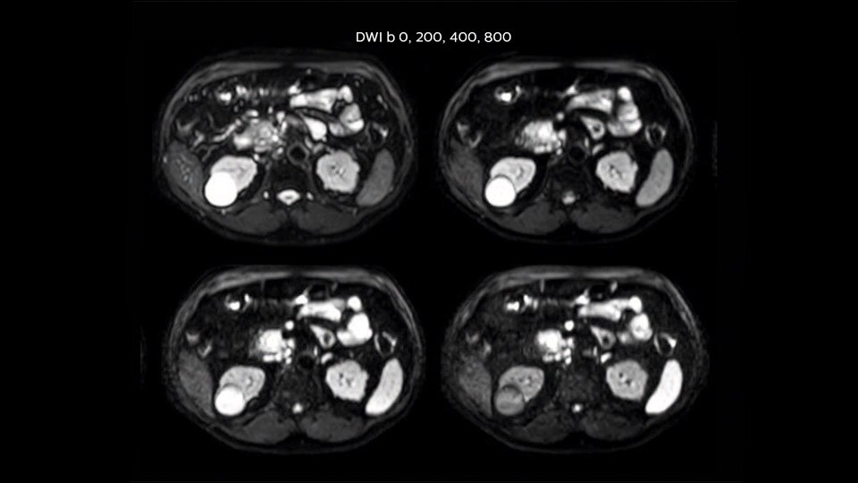 Bremen Case 2 Pancreas tumor 960px