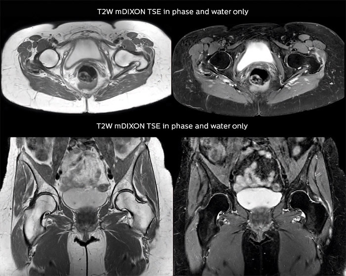 Lefebvre Case Hip MRI 960px