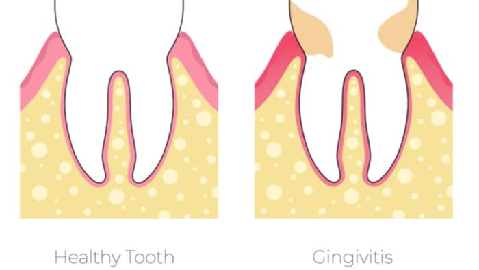 Healthy tooth gingivitis