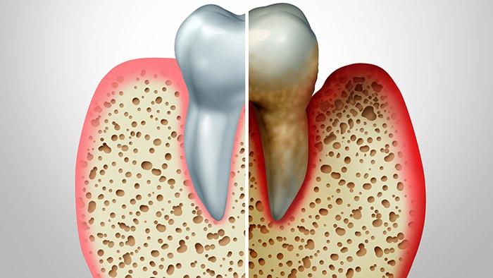 Periodontitis