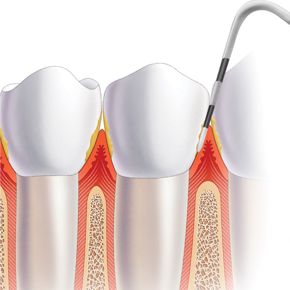 Gingival probe