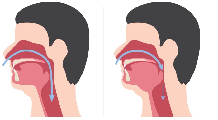 Non obstructed and obstructed airways